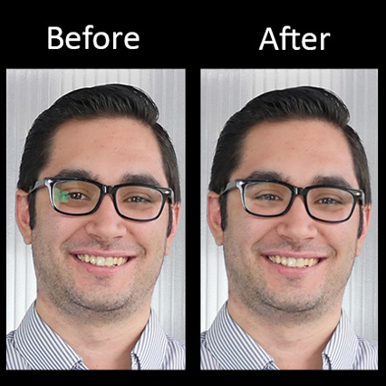 Before and after comparison showing a man with white teeth in the "After" image. Text: Before, After.